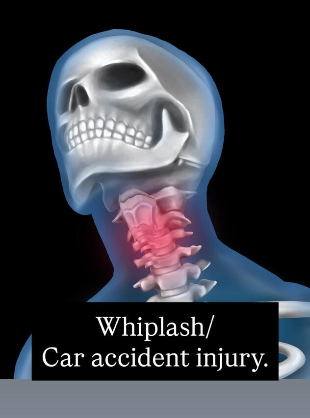 Car accident injury